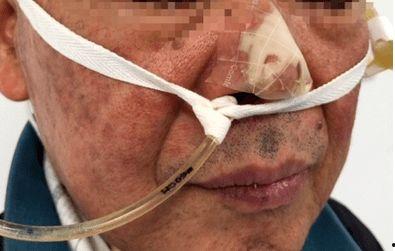 鼻穿刺视频,鼻穿刺操作步骤及要点解析